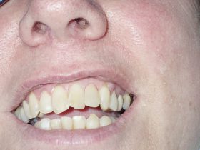 FIGURE 12: A more natural and aesthetically pleasing veneer